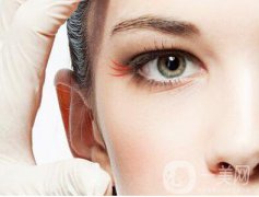 深圳鱼尾纹打玻尿酸要多少钱?