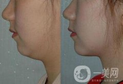双下巴吸脂注意事项介绍 双下巴吸脂多少钱