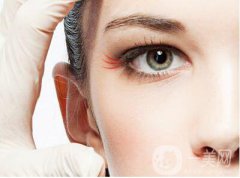 深圳去除鱼尾纹大概需要多少钱呢?