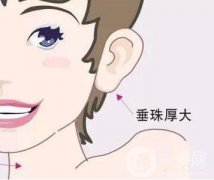 上海玻尿酸丰耳垂术要多少钱