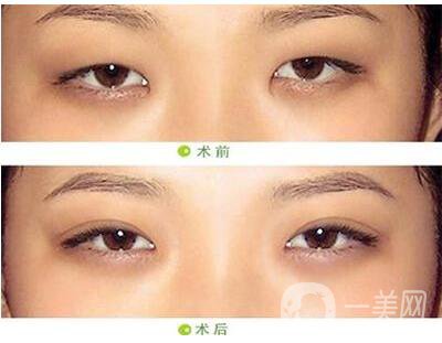 开眼角,开眼角手术过程,上海开眼角手术过程