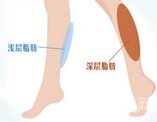 小腿吸脂手术后多久会*变瘦