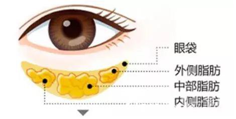 激光去眼袋术后如何护理 应该注意什么