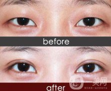 重庆埋线割双眼皮多少钱