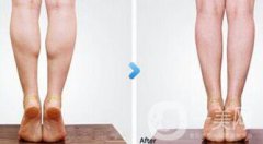 广州注射注射瘦腿一针多少钱