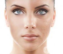 热玛吉有什么果 果怎么样