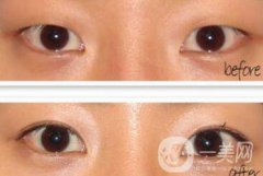 韩式开眼角整形果到底怎么样