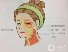 成都电波拉皮手术一般多少钱?