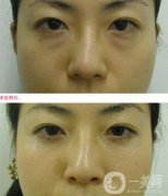 电波拉皮去眼袋果怎么样？