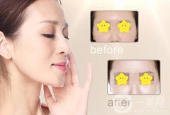 玻尿酸丰太阳穴多少钱？