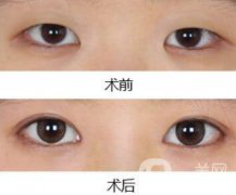 做开眼角手术前后注意事项具体是什么