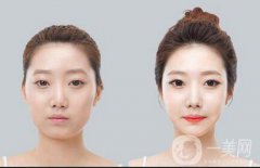 自体脂肪丰太阳穴果能维持多久？