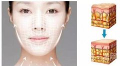 成都做一次热玛吉需要多少钱呢?注意事项有哪些?