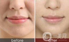 宁波手术去法令纹多少钱