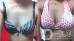 隆胸的危害有哪些 如何避免隆胸失败