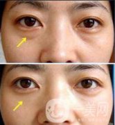 北京溶脂去眼袋价格是多少