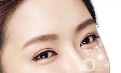 北京自体丰卧蚕多少钱?注意事项有哪些?