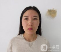 全开双眼皮和开眼角案例分享，变美就是这么简单！