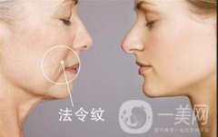 北京*去法令纹多少钱？