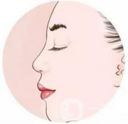 北京驼峰鼻矫正手术费用大概有多少