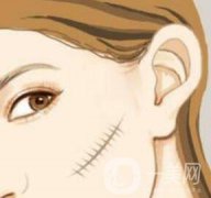 激光祛疤果怎么样？有什么优势