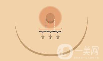 深圳乳头缩小费用