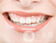 合金烤瓷牙能用几年呢?