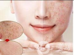 激光去晒斑*果吗