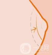 乳晕缩小整形手术价格是多少呢?