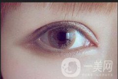 溶脂去眼袋修复价格一般是多少