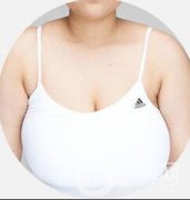 巨乳缩小术贵吗？巨乳缩小多少钱？