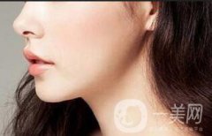 垫下巴多长时间恢复？