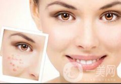 光子嫩肤的优势有哪些