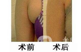 副乳切除多少钱