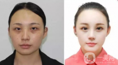 光子嫩肤价格多少钱 什么是光子嫩肤