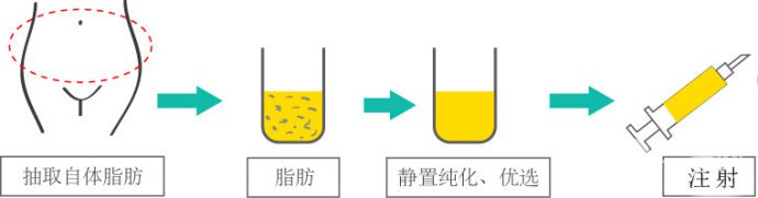 自体脂肪填充疼吗 自体脂肪填充怎样