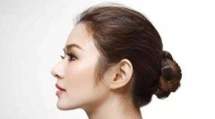 假体隆鼻要花多少钱 假体隆鼻果好吗？