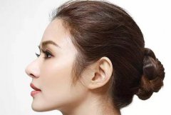 隆鼻手术一般多少钱 隆鼻贵不贵