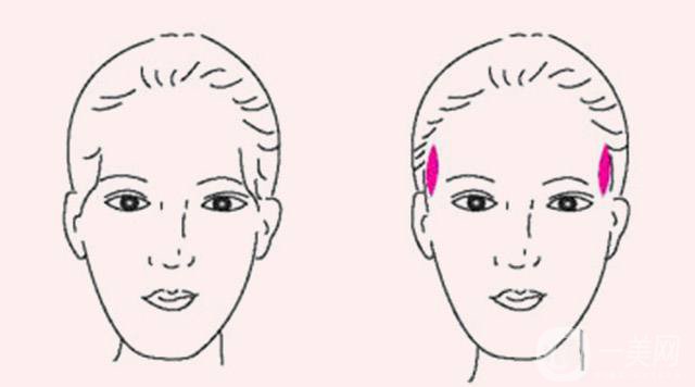 玻尿酸丰太阳穴报价 玻尿酸丰太阳穴的方法