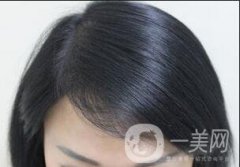 发际线种植恢复期需要多久