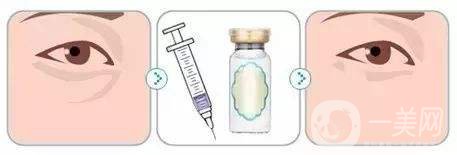 玻尿酸能填充泪沟吗 玻尿酸手术*果