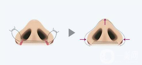 鼻翼缩小手术价格 鼻翼缩小方法