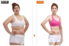 抽脂手术后需要多久恢复 果能维持多久