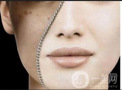 激光祛除黄褐斑果怎么样 激光祛除黄褐斑注意事项