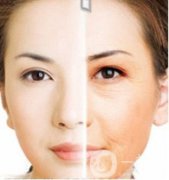 prt是什么 是电波拉皮吗？