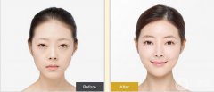 开内外眼角果如何？开眼角前后照片