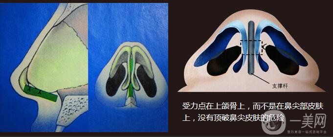 医生测评：自体隆鼻专家 张笑天