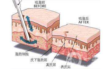 北京抽脂多少钱 抽脂手术*吗