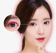 亚韩割双眼皮多少钱？什么人不适合做这项手术呢？