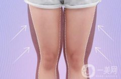女性大腿吸脂一般多久恢复?*吗?
